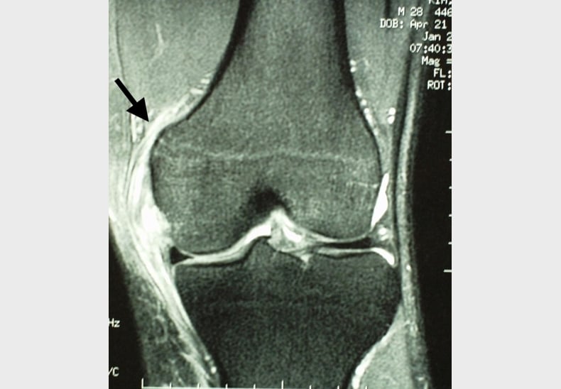 Lateral Collateral Ligament 