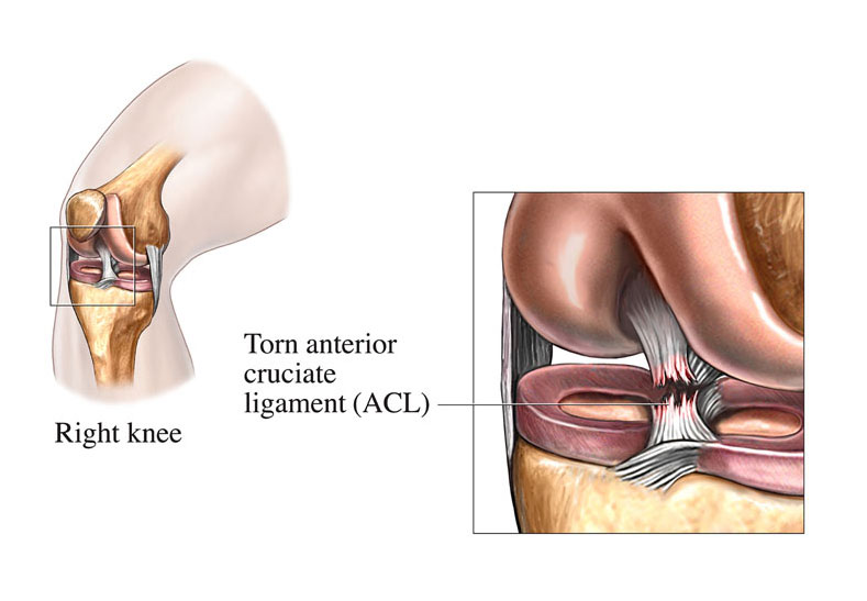 Image – Anterior cruciate ligament injury